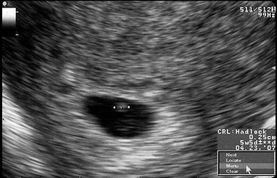Ultrasound of baby at 4 weeks