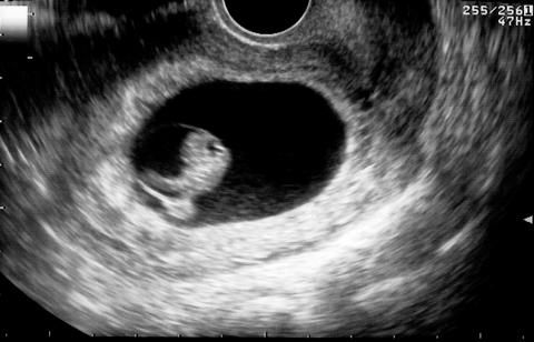 Ultrasound of baby at 8 weeks