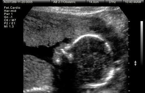 Ultrasound of baby at 24 weeks