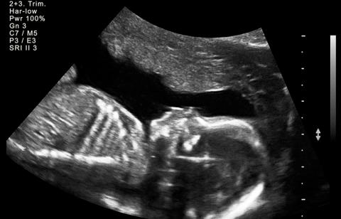 Ultrasound of baby at 32 weeks